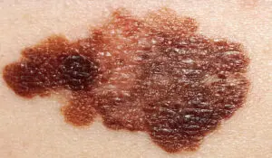 Cutaneous Disorders