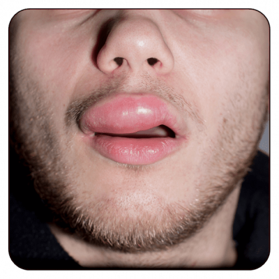 Treatment of Allergic and Nonallergic Angioedema